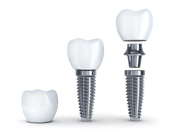 Какими плюсами обладает имплантация зубов?